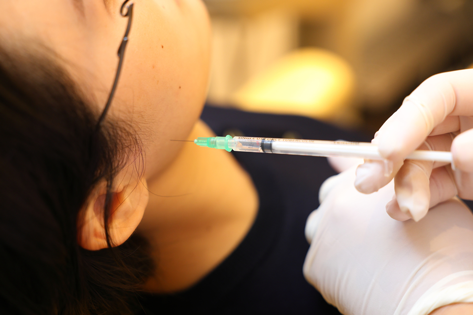 ボトックス注射(咬筋ボツリヌス治療)