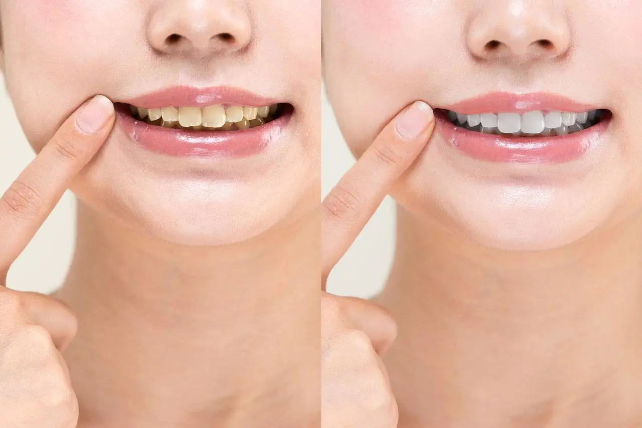 歯のホワイトニングとは