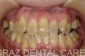 【50代女性】インビザラインによる6本抜歯矯正｜受け口傾向・前歯のズレを1年半で改善　治療前