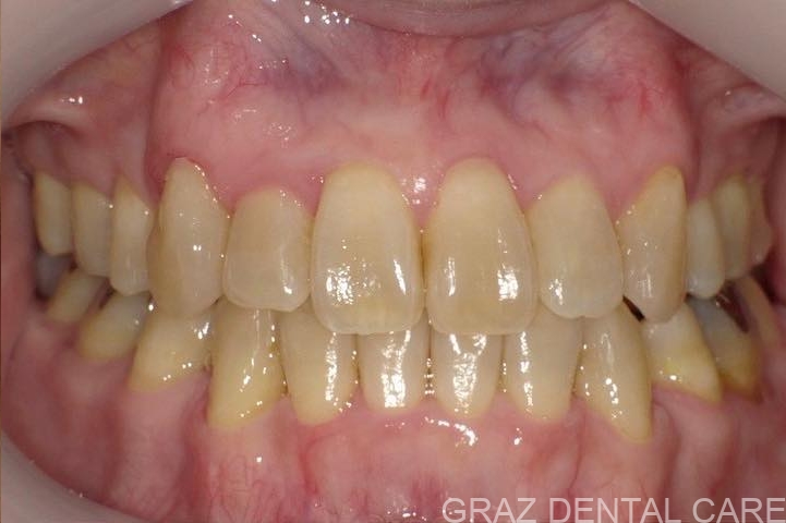 【50代女性】インビザラインによる6本抜歯矯正|受け口傾向・前歯のズレを1年半で改善 治療後