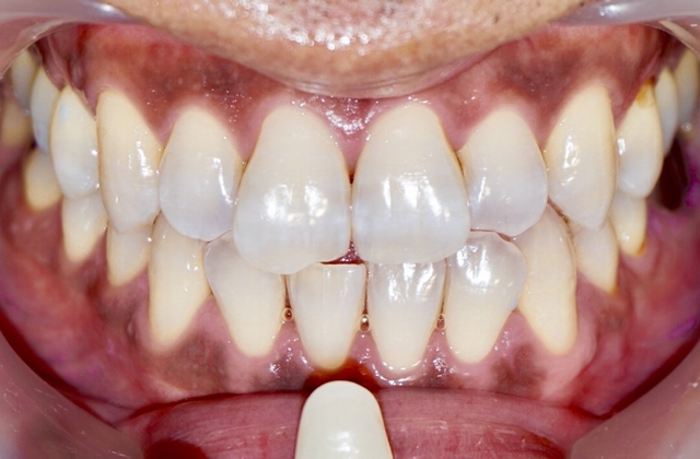 過去ホワイトニングでしみてホワイトニングを断念した治療後