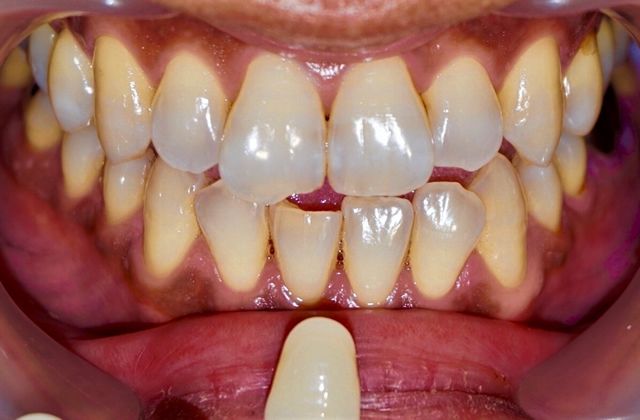 過去ホワイトニングでしみてホワイトニングを断念した治療前