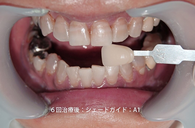 テトラサイクリング症後