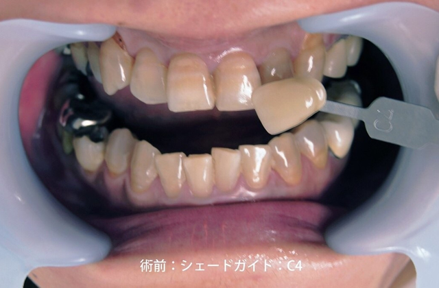 テトラサイクリング症前