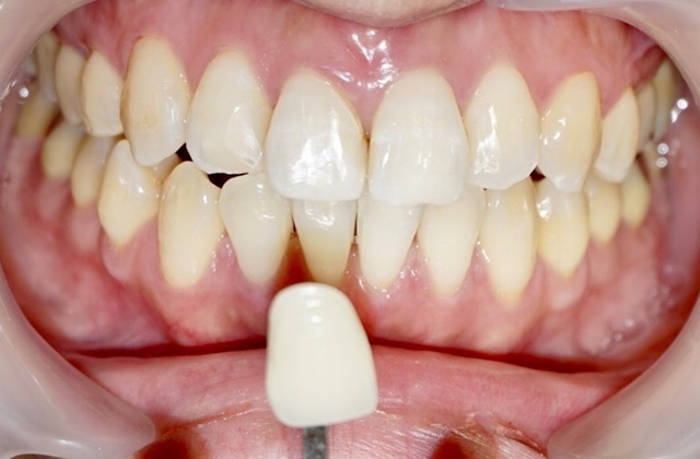 ホワイトニング後