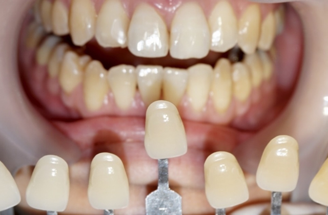 ホワイトニング前