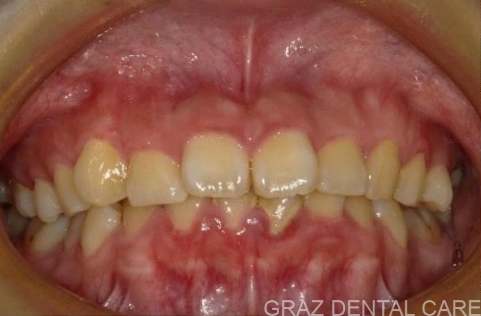 【20代女性】出っ歯を非抜歯で改善！マウスピース矯正で叶えた理想のスマイルライン