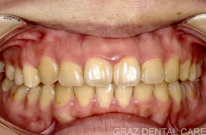 20代女性の矯正治療後