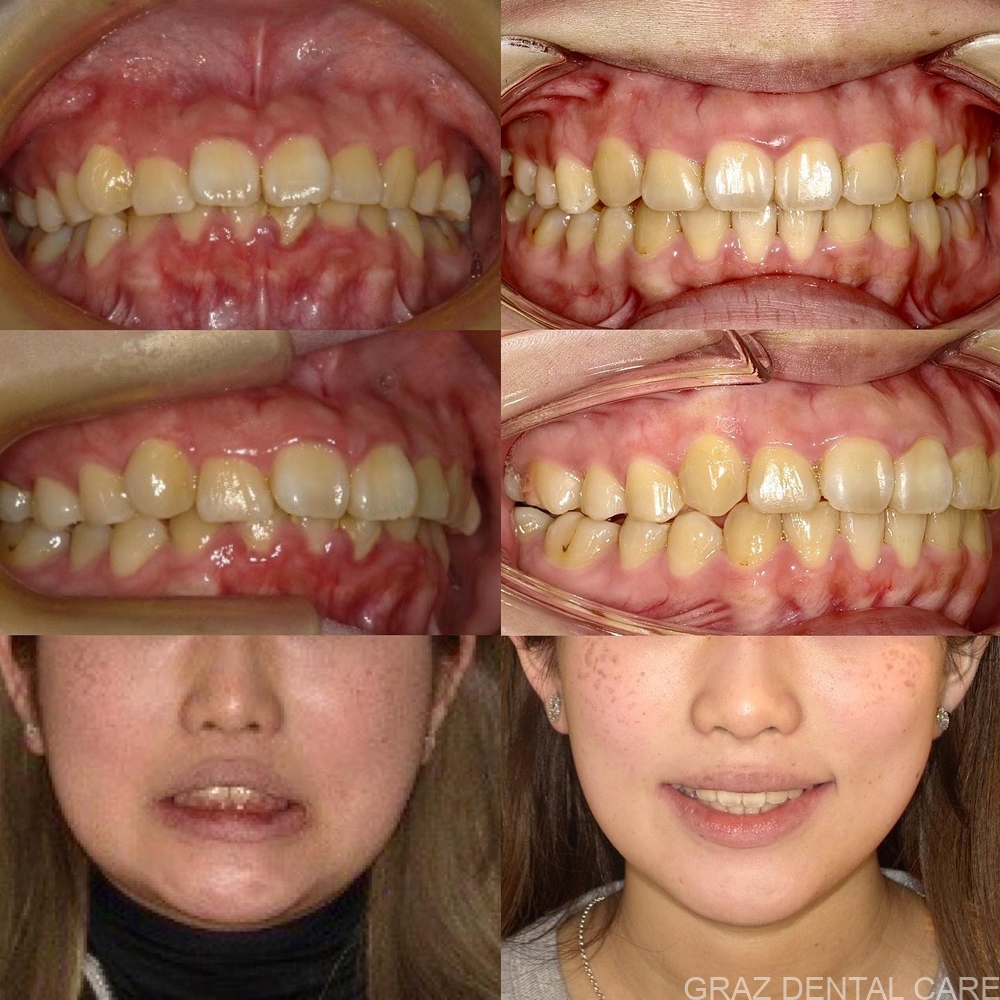 20代女性の矯正治療写真
